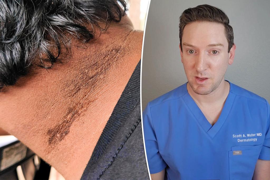 The dermatologist reveals that acanthosis nigricans can mean cancer